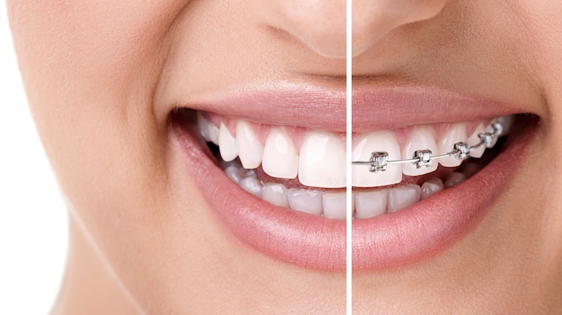 braces-orthodontist-oc-la